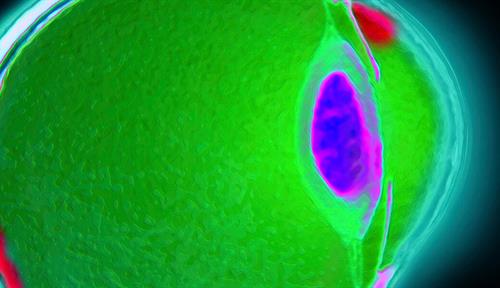 Close-up colored photograph of a side-view of the eye shows structural details such as the cornea, lens, eyeball and optic nerve. Glaucoma is a common cause of blindness.