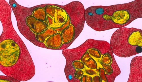 Microscopic image shows malaria parasites infecting red blood cells.