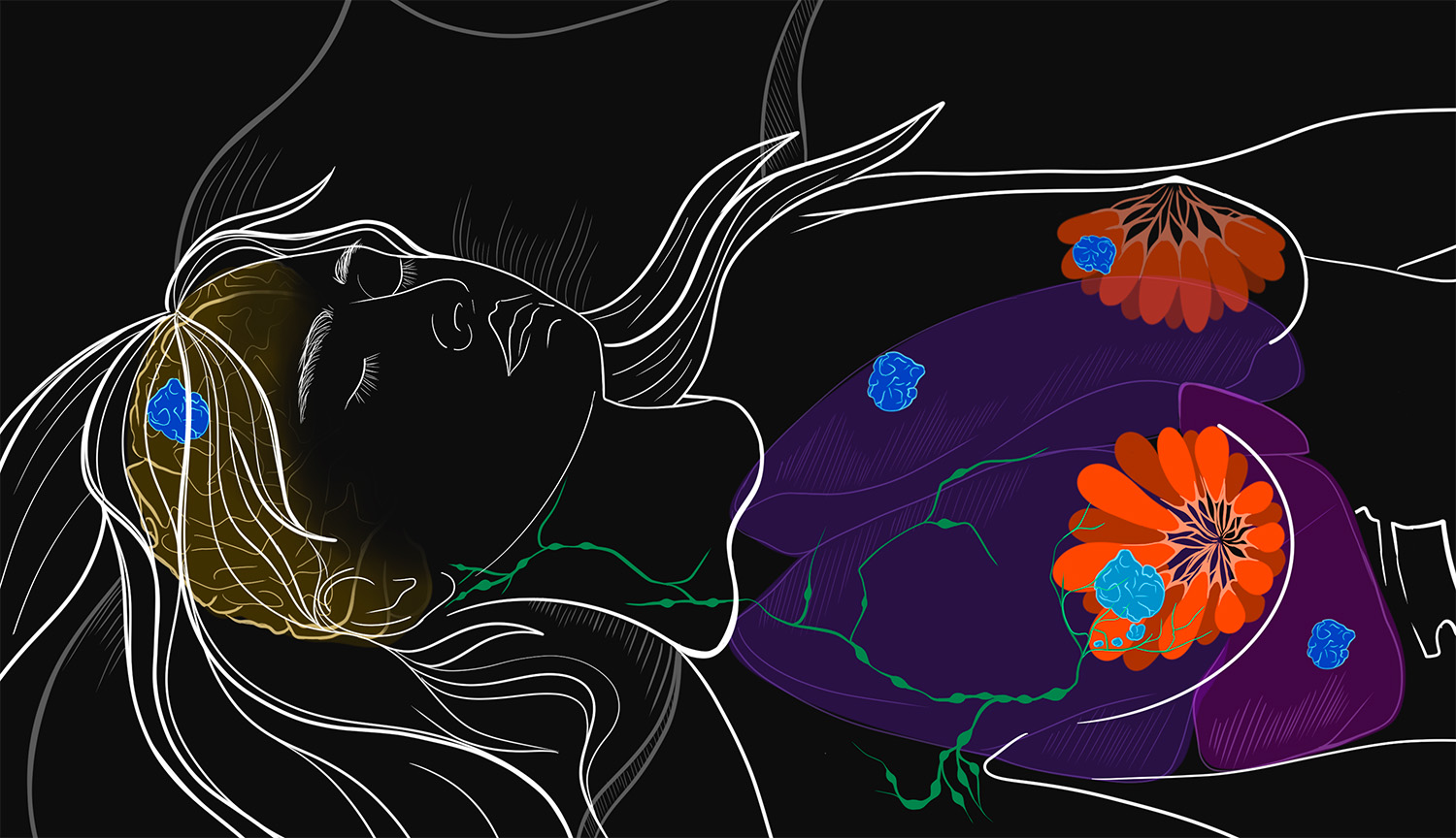 Illustration of a woman shows a primary tumor in breast that has spread to other body parts.