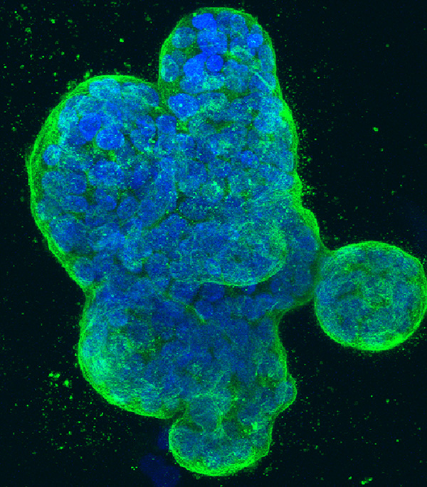 Microscopic image shows a three-dimensional culture of breast cancer cells, artificially colored blue and green.